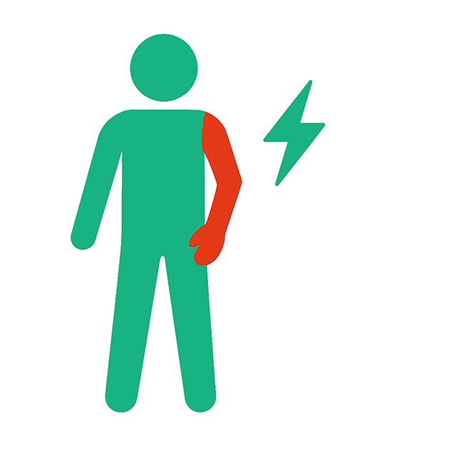 筋麻痺の説明画像